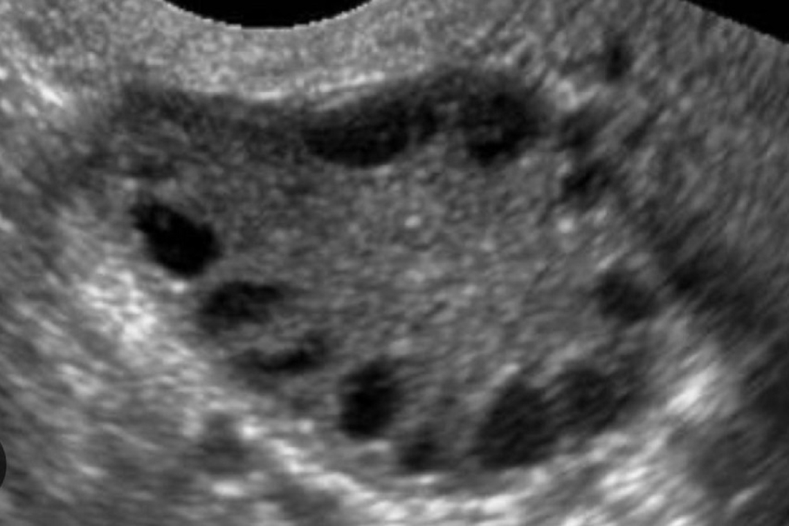 La Sindrome dell’Ovaio Policistico e la Fertilità